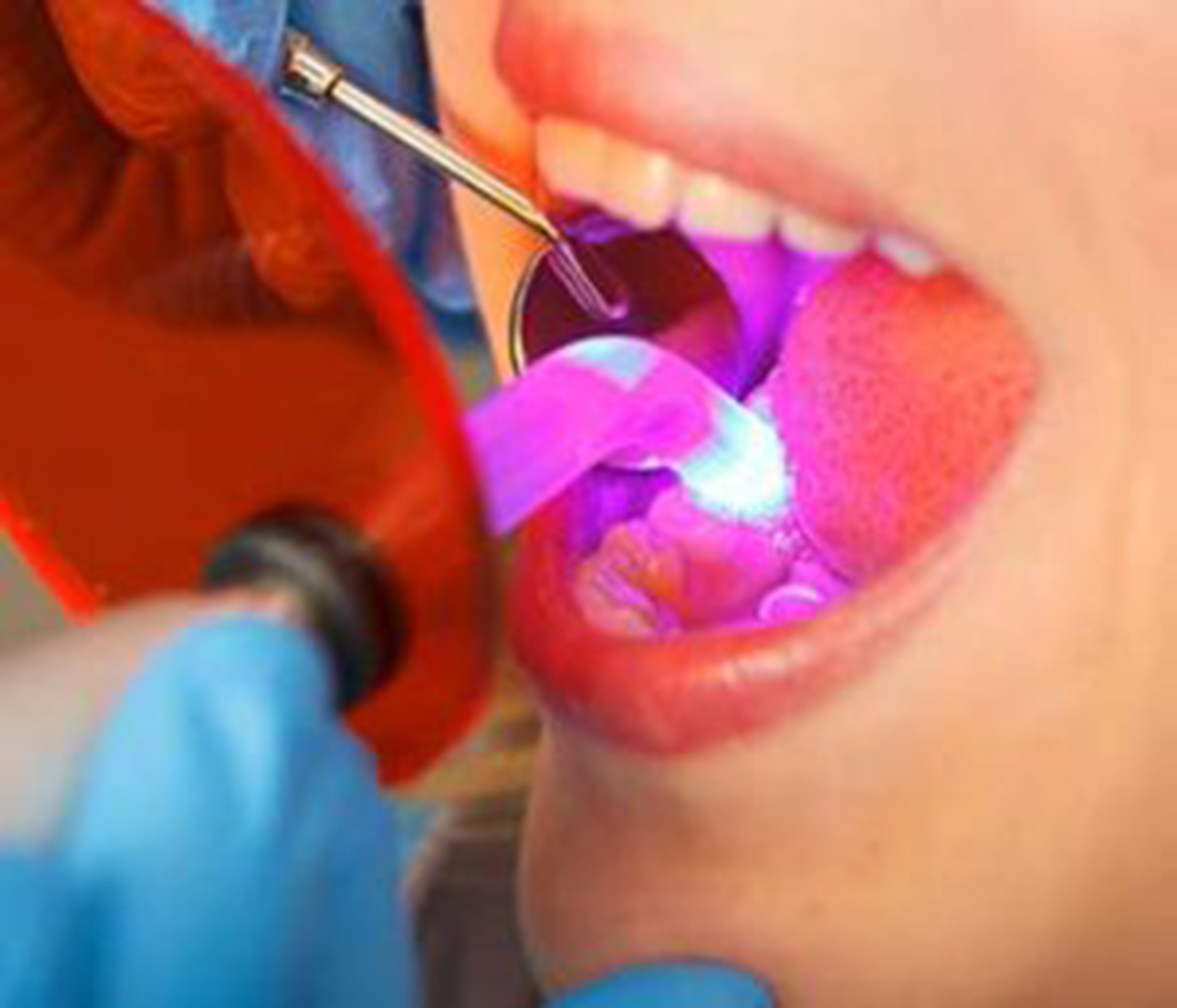 Dentist doing a Ozone treatment for a patient
