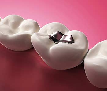 3d render of teeth with gold, amalgam and composite inlay dental filling in gums